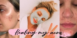 how i healed my acne